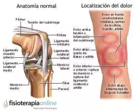 Causa, síntomas y tratamiento de la Pata de Ganso