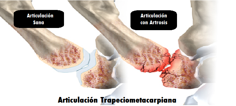 diferencia de una articulación sana con una con artrosis de pulgar