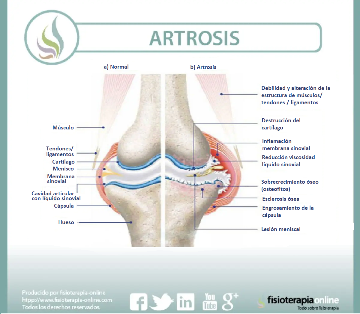 Características de una articulación sana y una con artrosis