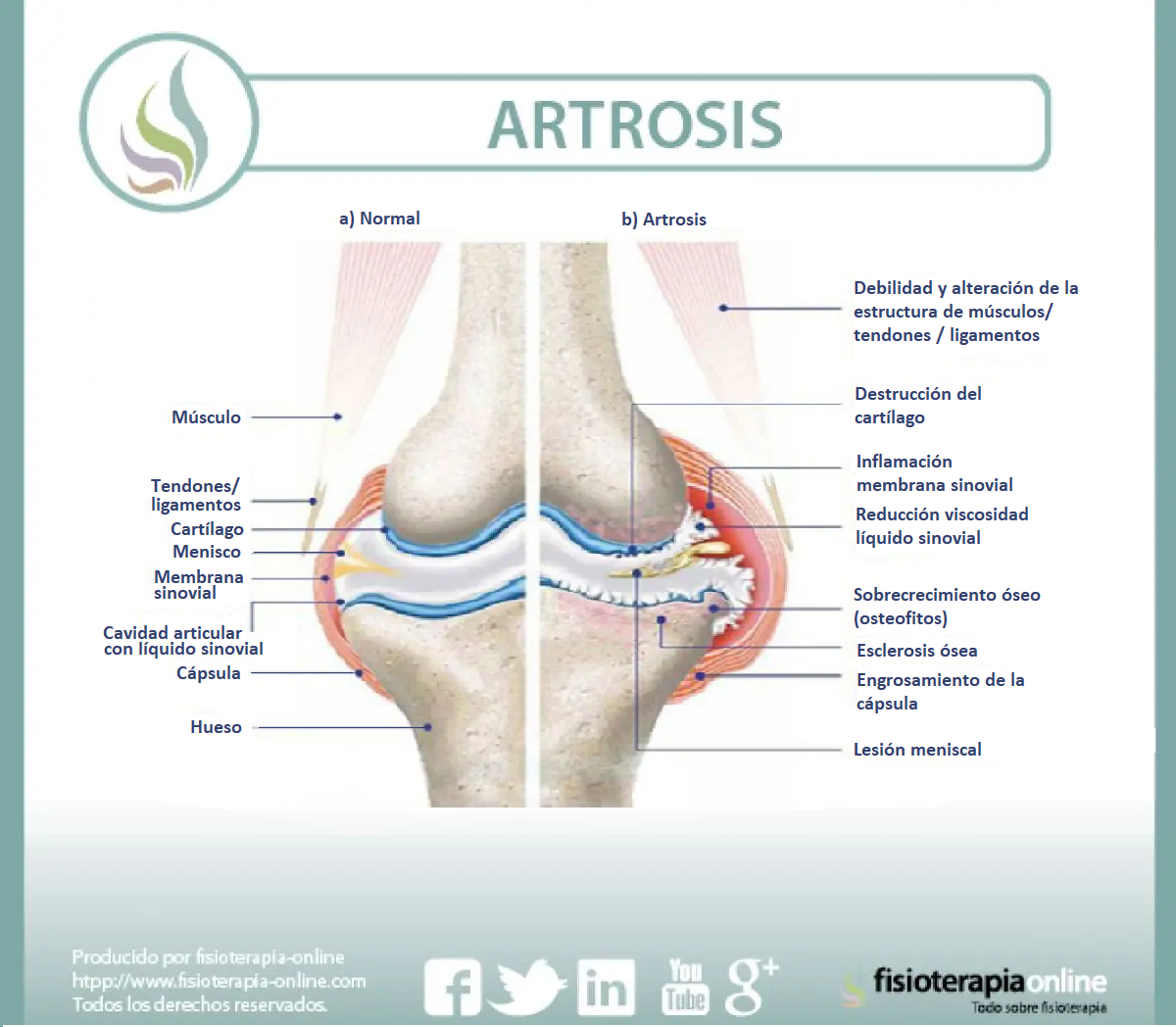 Artrosis de Rodilla: Causas, Síntomas y Tratamientos - Incar - Clínica Osten