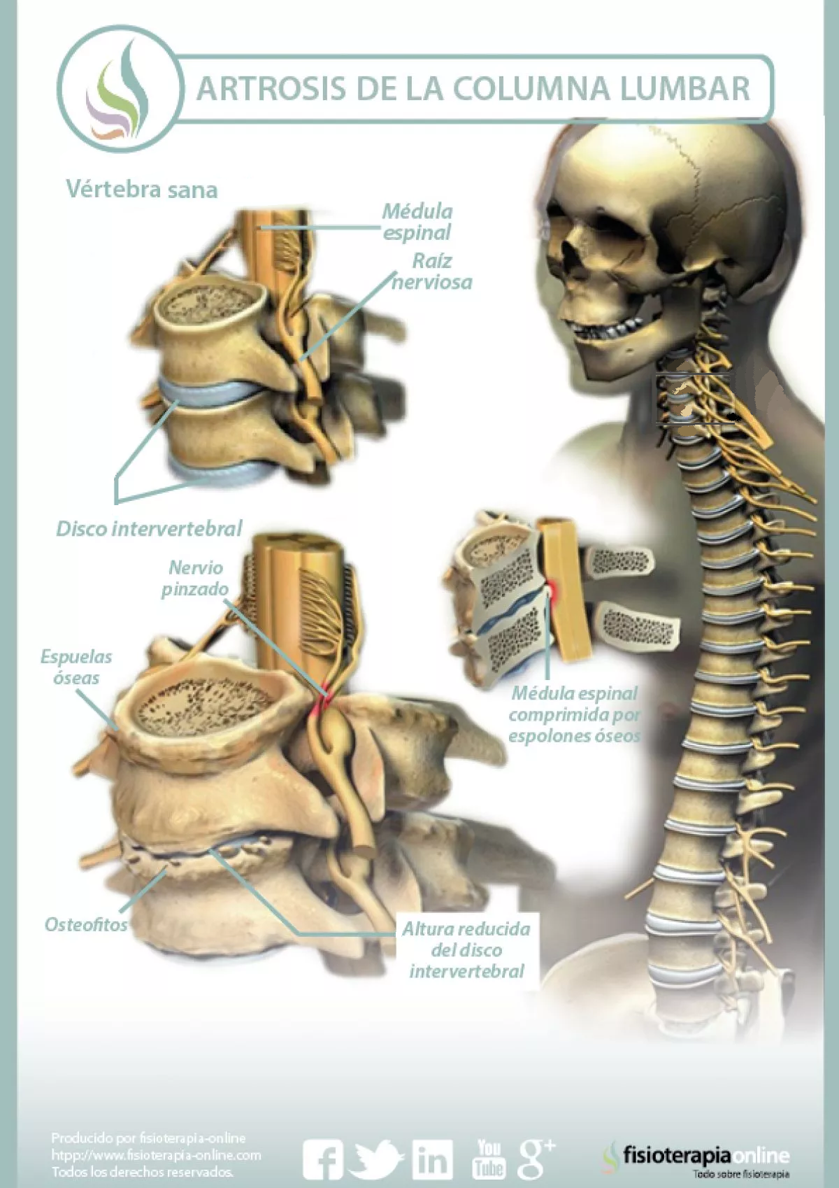 Artrosis de la columna lumbar