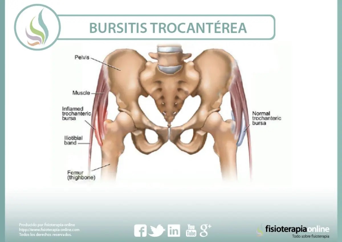bursitis trocantérea 