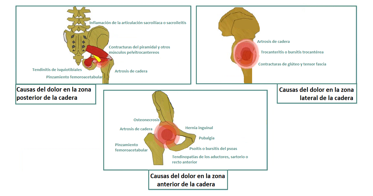Causas del dolor de cadera por zona afectada