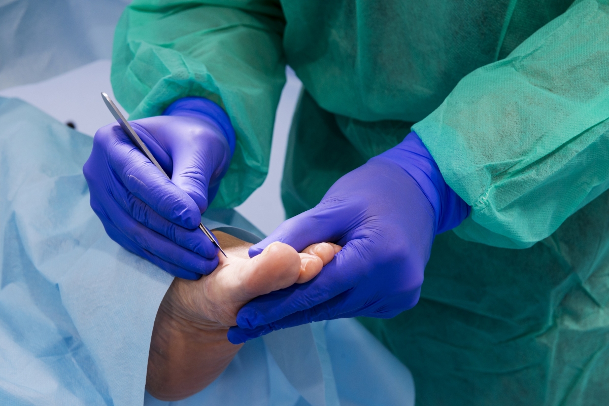 cirugía de juanete o hallux valgus 