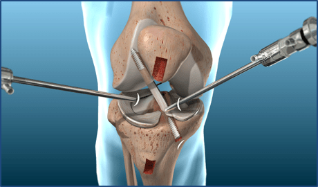 cirugía de ligamentos cruzados 