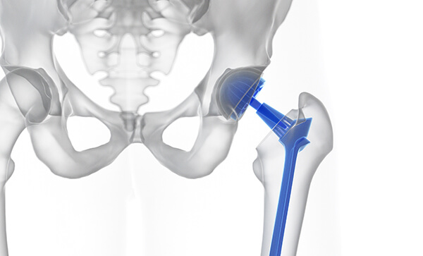 Cirugía de prótesis de cadera 