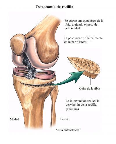 Cirugía de valgo y varo de rodilla 