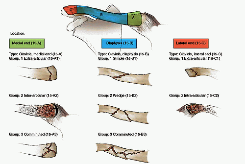 clasificación para fracturas de clavícula de la AO/OTA