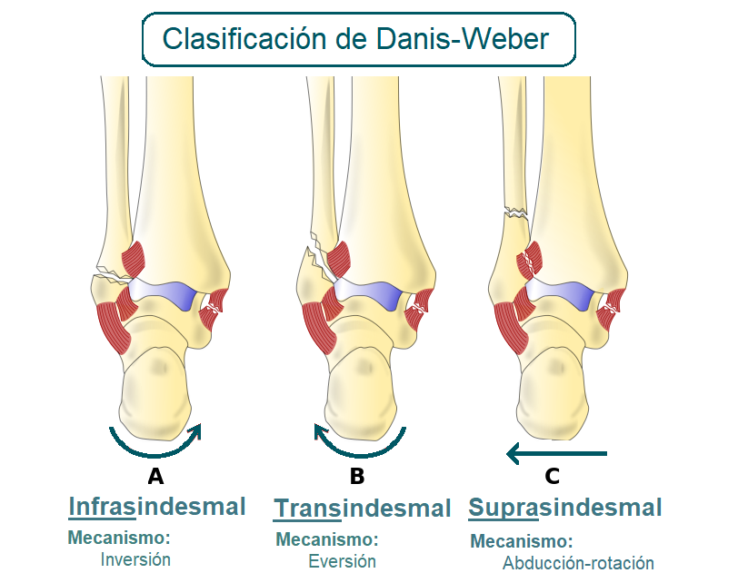 Clasificación de las fracturas distales de peroné