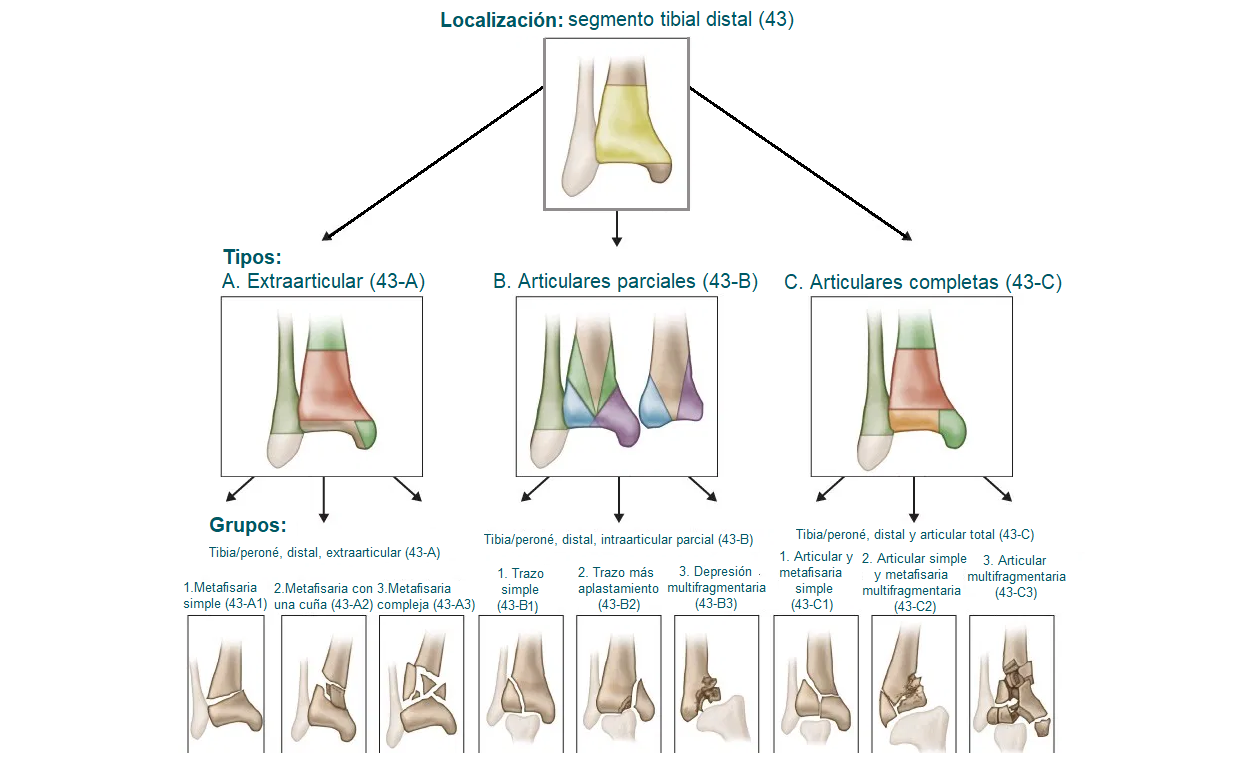 Clasificación de las fracturas distales de tibia