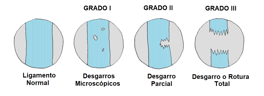 Clasificación del esguince de rodilla