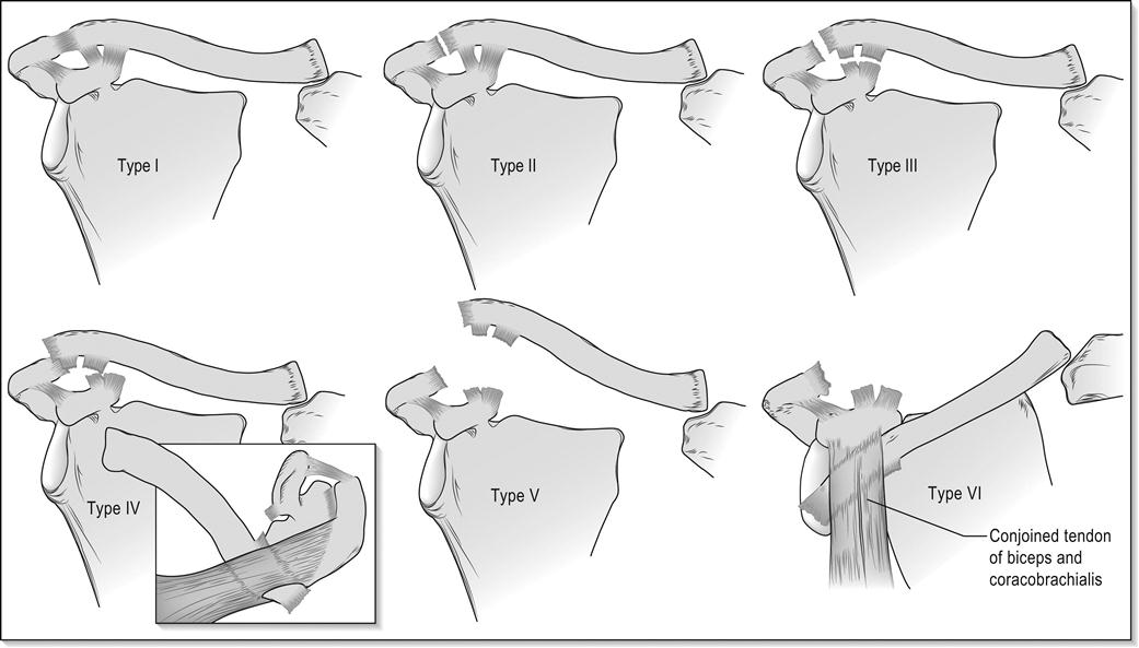 clasificación de la luxación acromioclavicular según rockwood