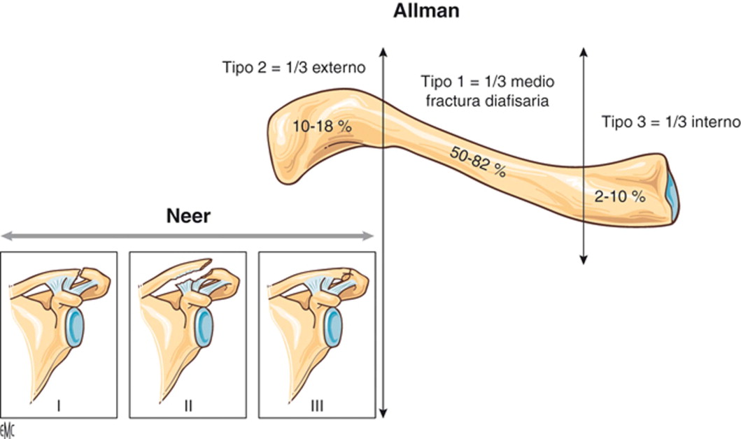 clasificaciones propuestas por Allman y Neer