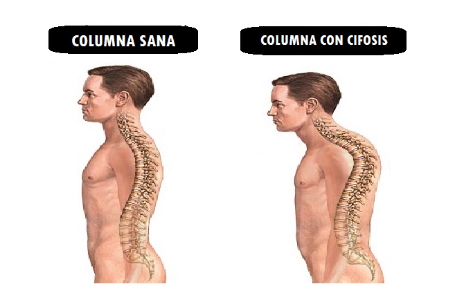 Columna vertebral sana y con cifosis dorsal