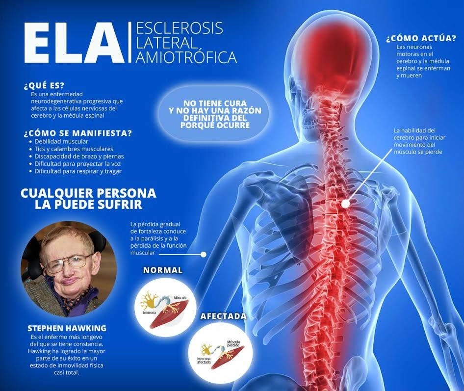 Sintomas de la esclerosis lateral amiotrofica 