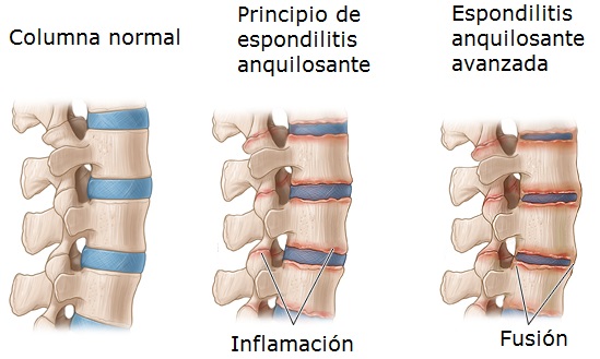 Cómo se desarrolla la espondilitis anquilosante