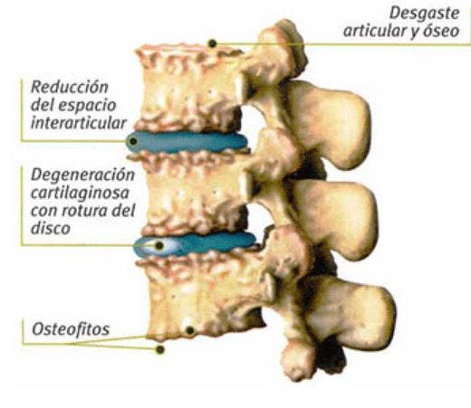 Complicaciones y alteraciones que produce la Artrosis cervical