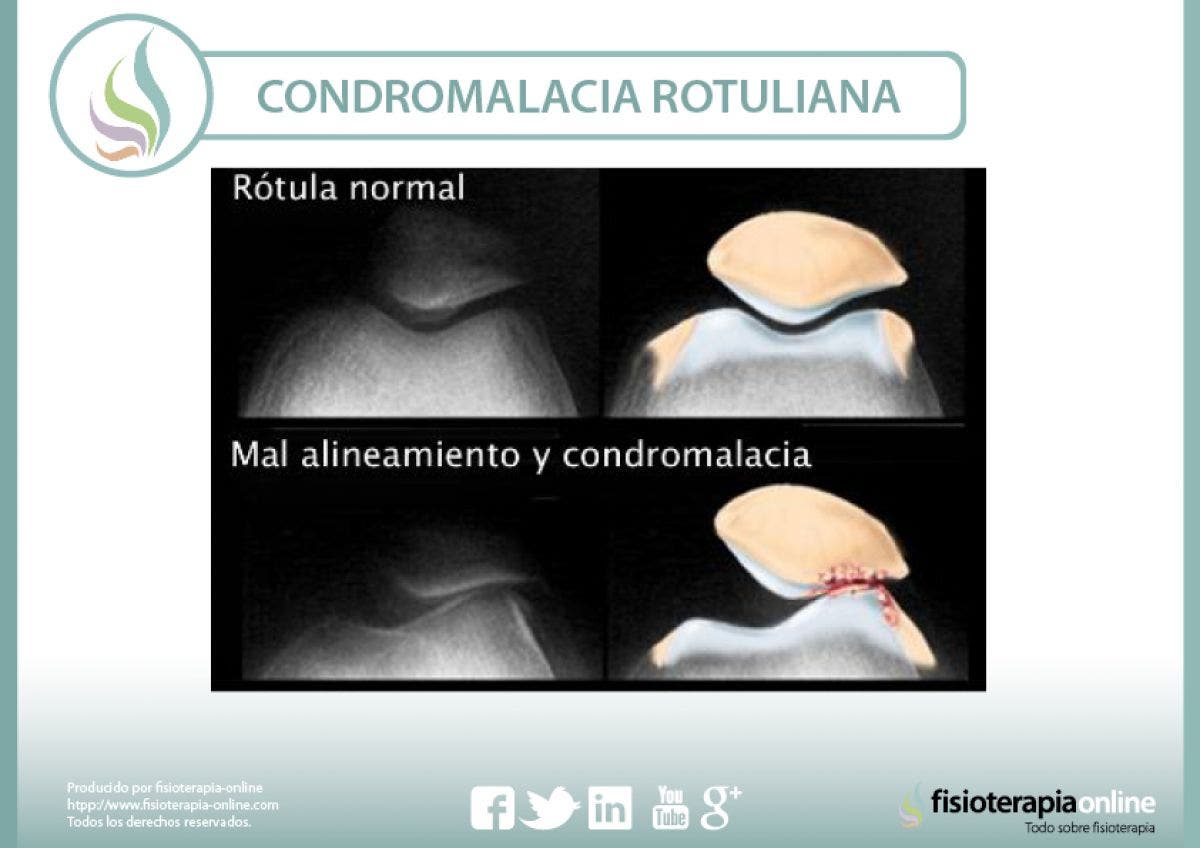 Condromalacia Rotuliana