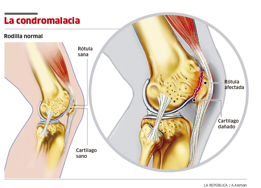 condromalacia rotuliana