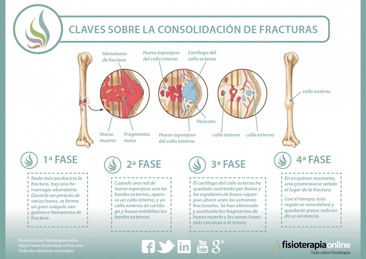 Proceso de consolidación de una fractura ósea