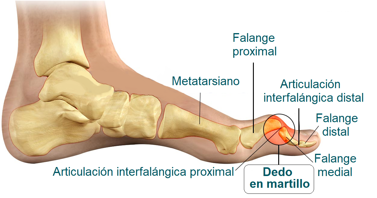 Dedo en Martillo