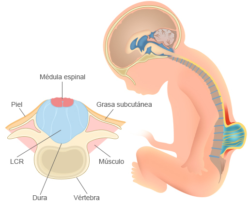 defectos del tubo neural