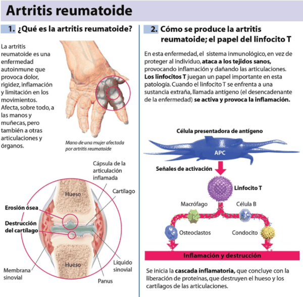 Cómo se desarrolla la artritis reumatoide