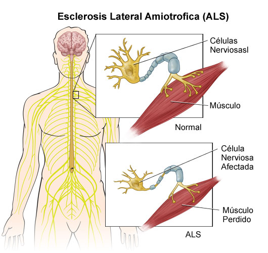 desarrollo esclerosis amiotrofica