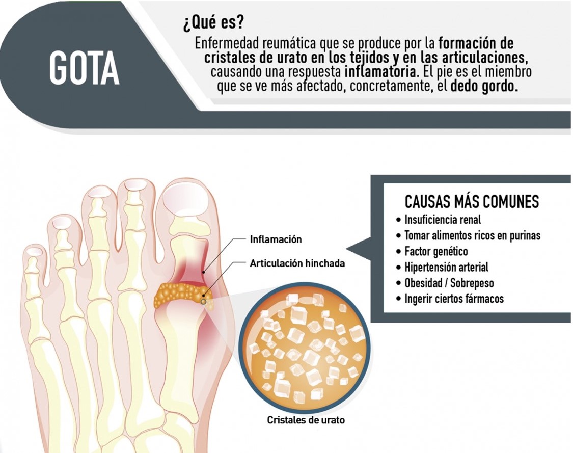 Desarrollo de la gota