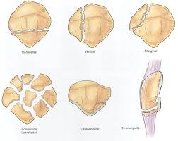 Fracturas de rótula. Clasificación, síntomas, diagnóstico y tratamiento en fisioterapia