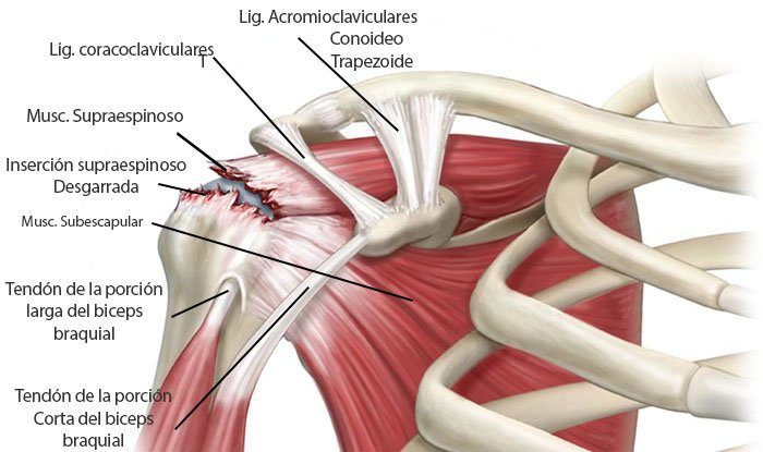 Desgarro o rotura del manguito rotador del hombro. Causas, síntomas y tratamiento