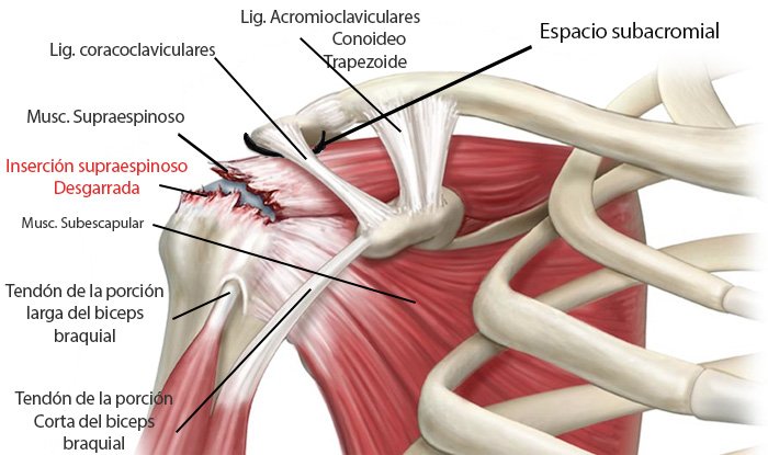 Lesión de hombro: Tendinitis del supraespinoso. ¿Qué es? Causas, ejercicios y tratamiento