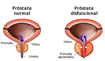 hidroterapie pentru prostatită tratament pentru prostata naturist