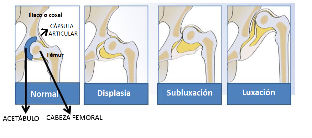 Tipos de displasia de cadera