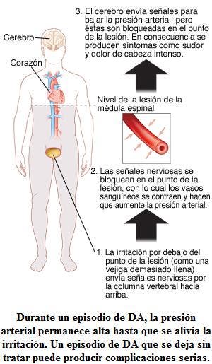 disreflexia autonoma complicacion