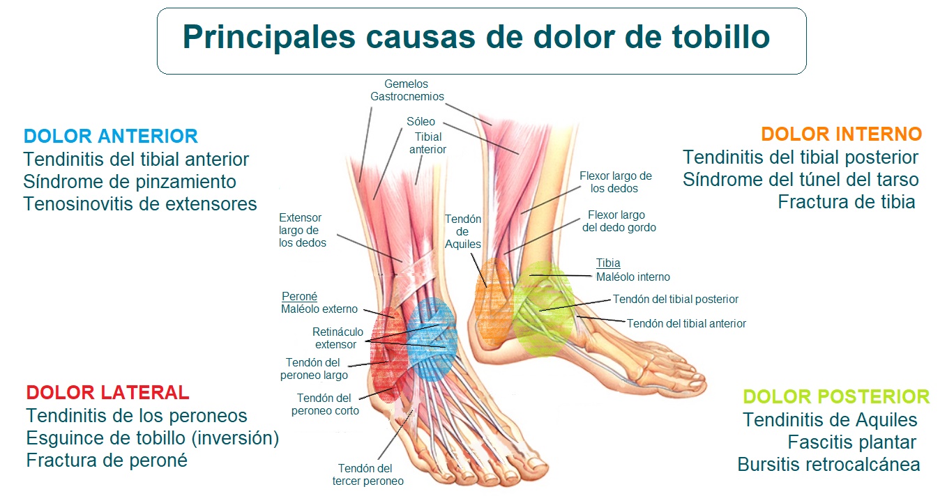 Cuanto tiempo dura un esguince de tobillo