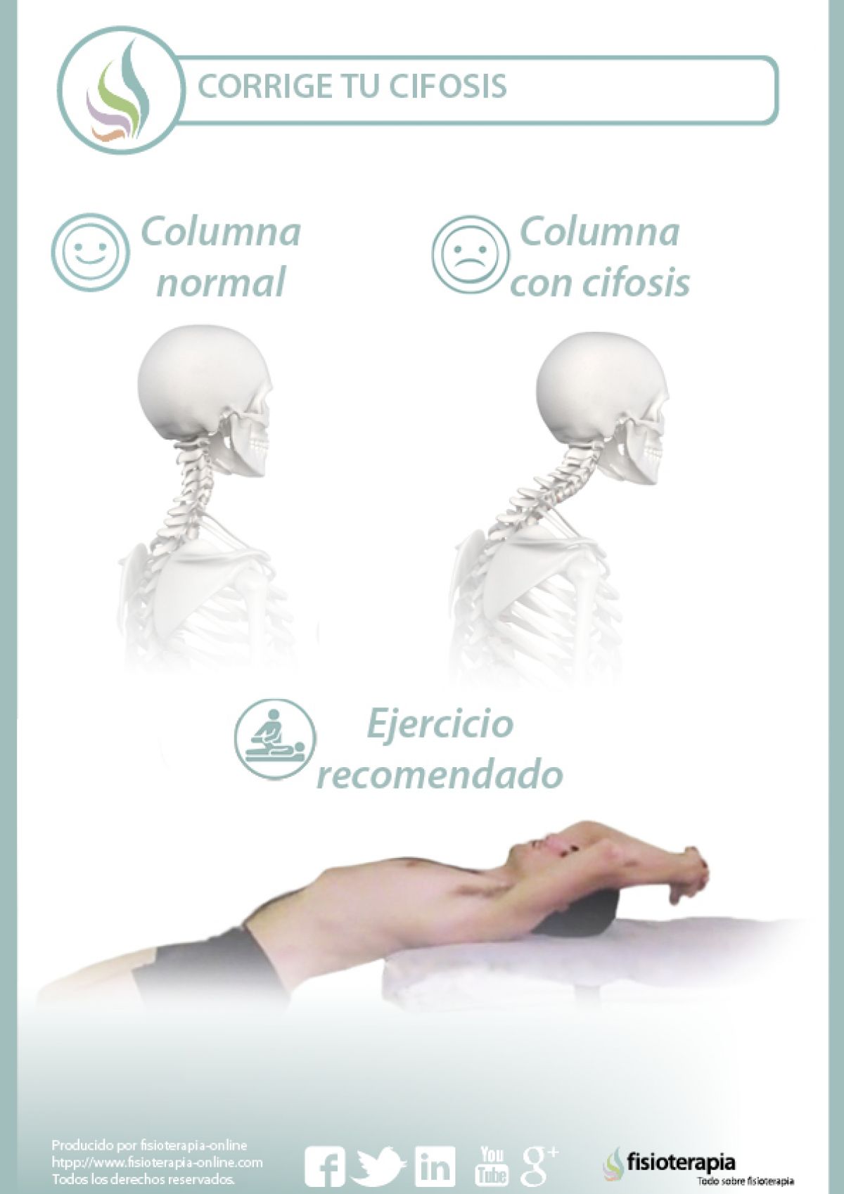 Qué es la cifosis: síntomas, causas y tratamiento