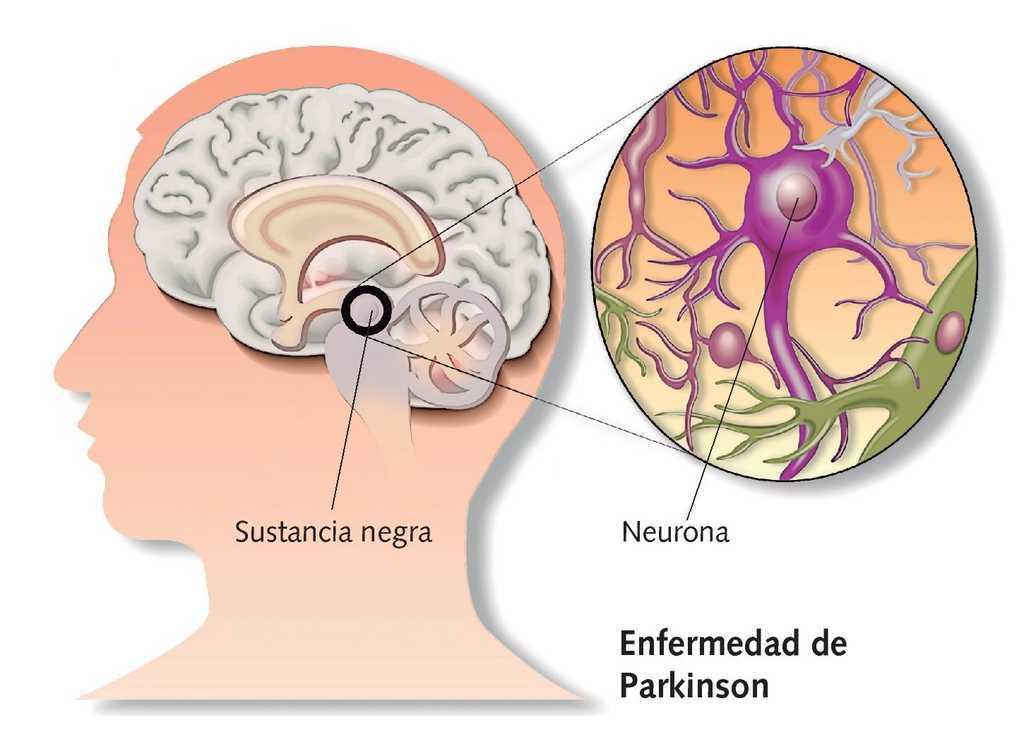 Enfermedad de Parkinson