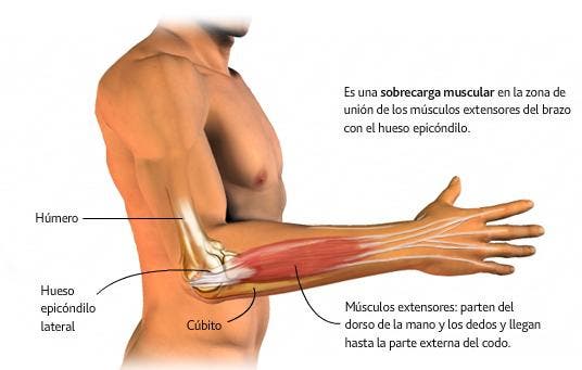 epicondilitis o codo de tenista 