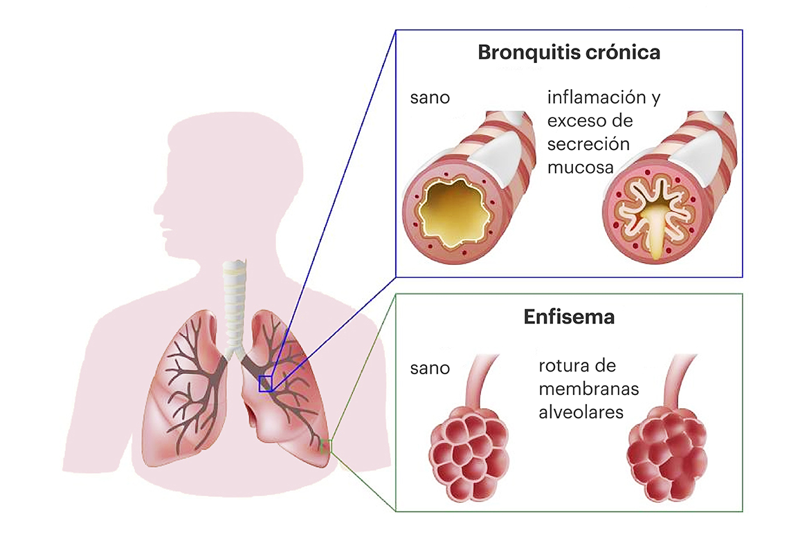 Enfermedades que constituyen la EPOC