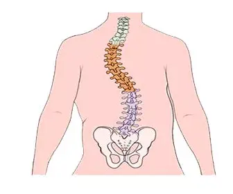 ¿Qué es la escoliosis? Causas, síntomas, diagnóstico y tratamiento