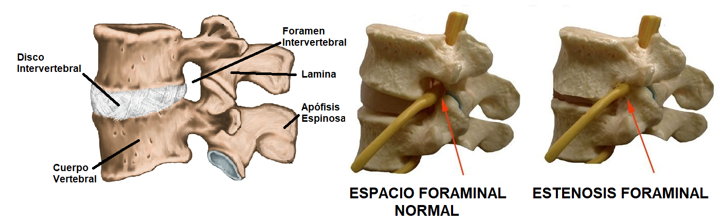 anatomía de la estenosis foraminal