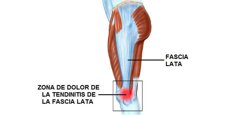 ubicación de la fascia lata