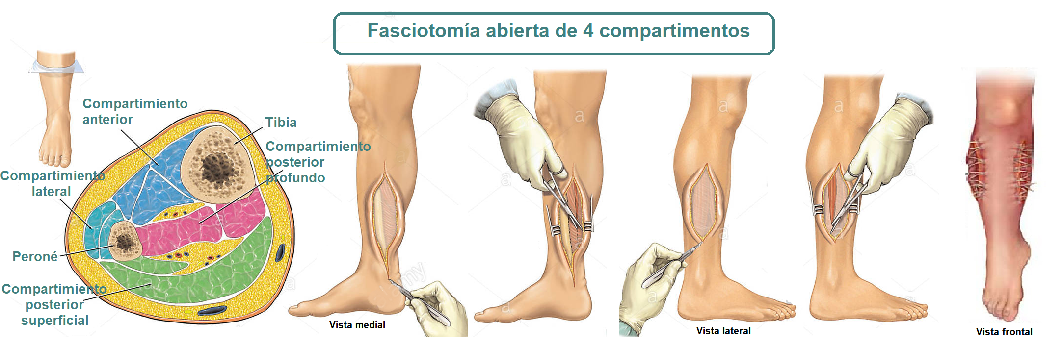 Fasciotomia