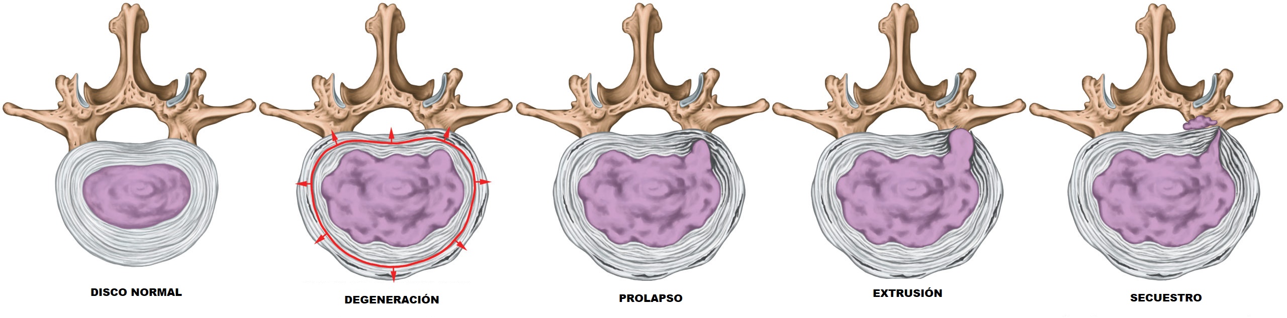 fases de degeneracion de la hernia discal