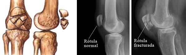 Fracturas de rótula. Clasificación, síntomas, diagnóstico y tratamiento en fisioterapia