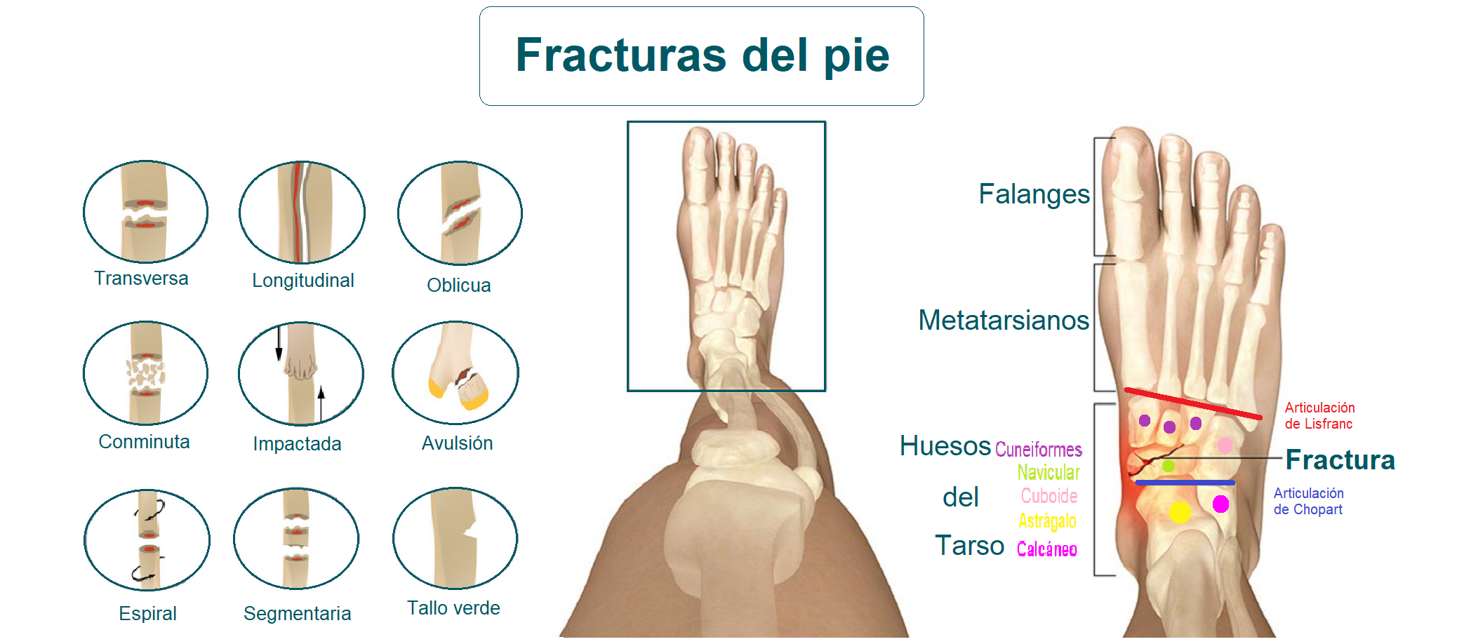 Fracturas del pie