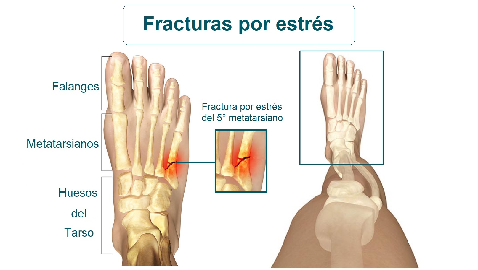 Fracturas por estrés