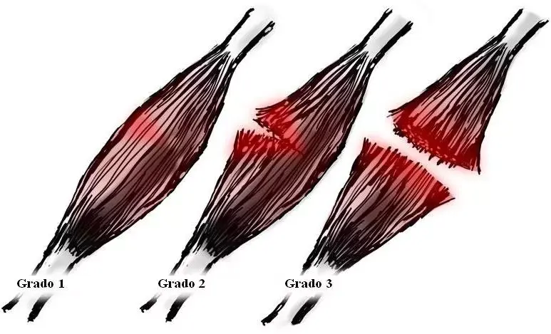 Rotura de fibras o desgarro muscular. Tratamiento, ejercicios y recuperaciÃ³n