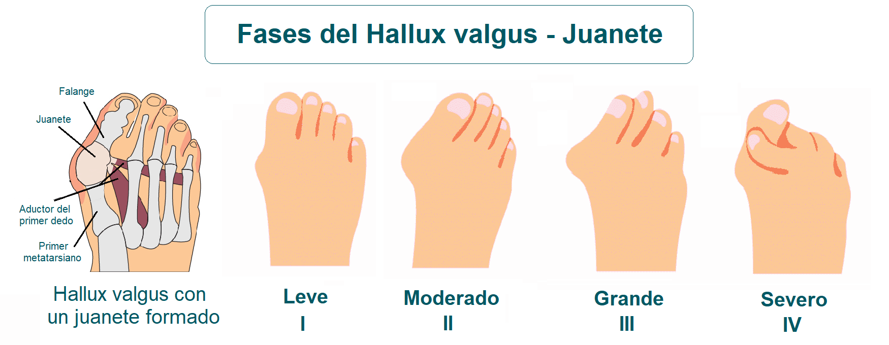 Grados o fases del hallux valgus o juanete